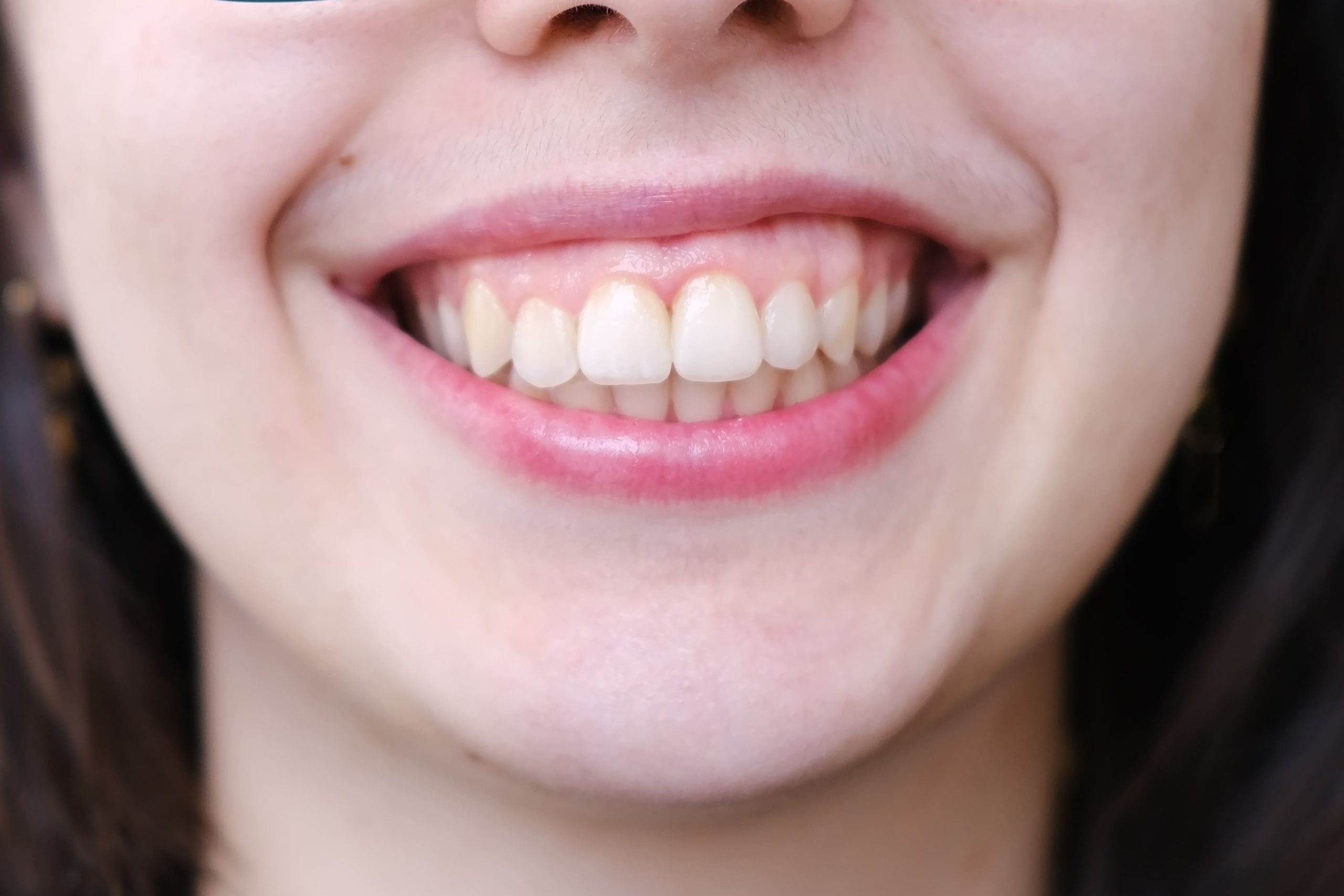 ¿Qué causa la sonrisa gingival y cuáles son los tratamientos?