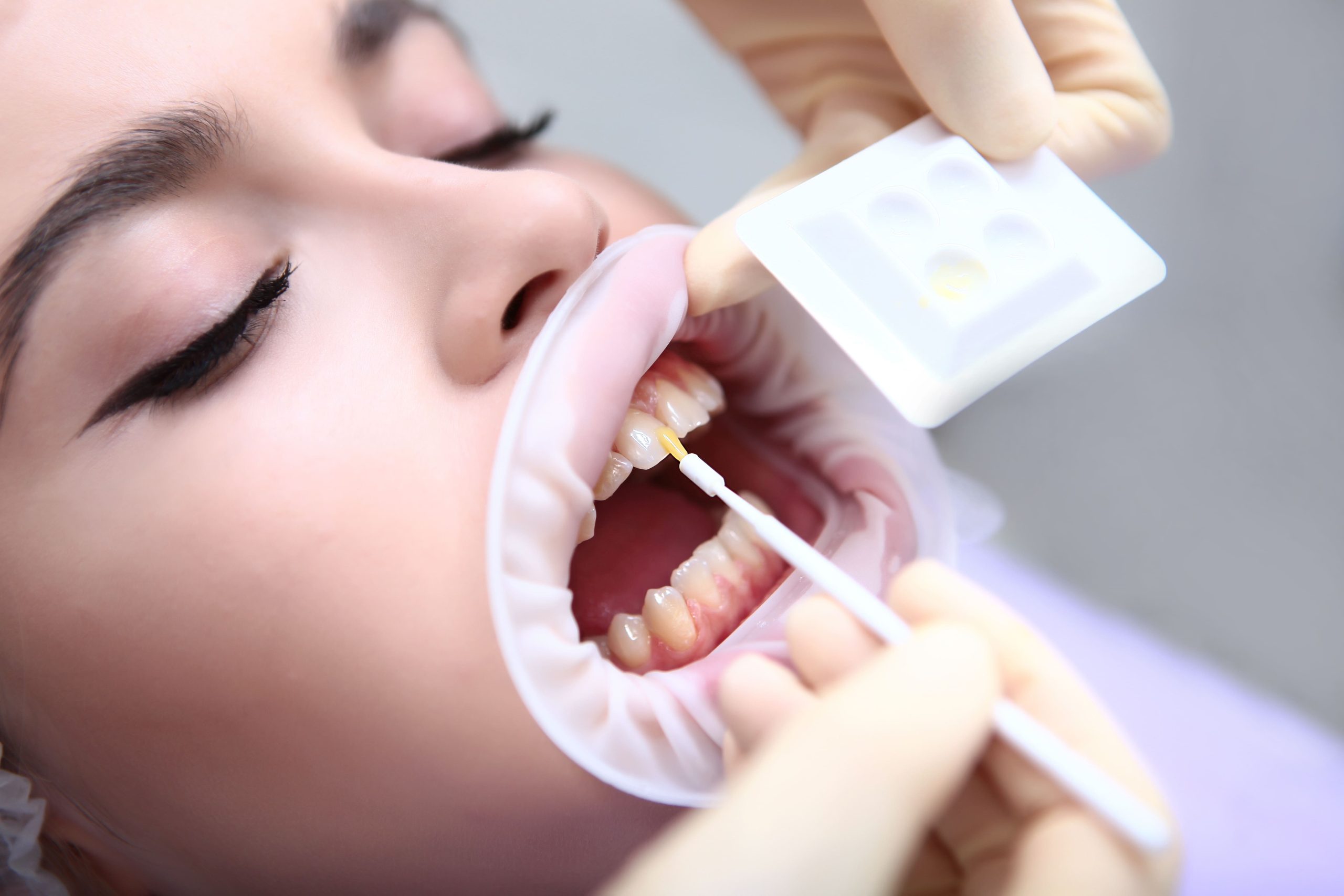 Flúor dental: una alternativa para la prevención y tratamiento de las caries