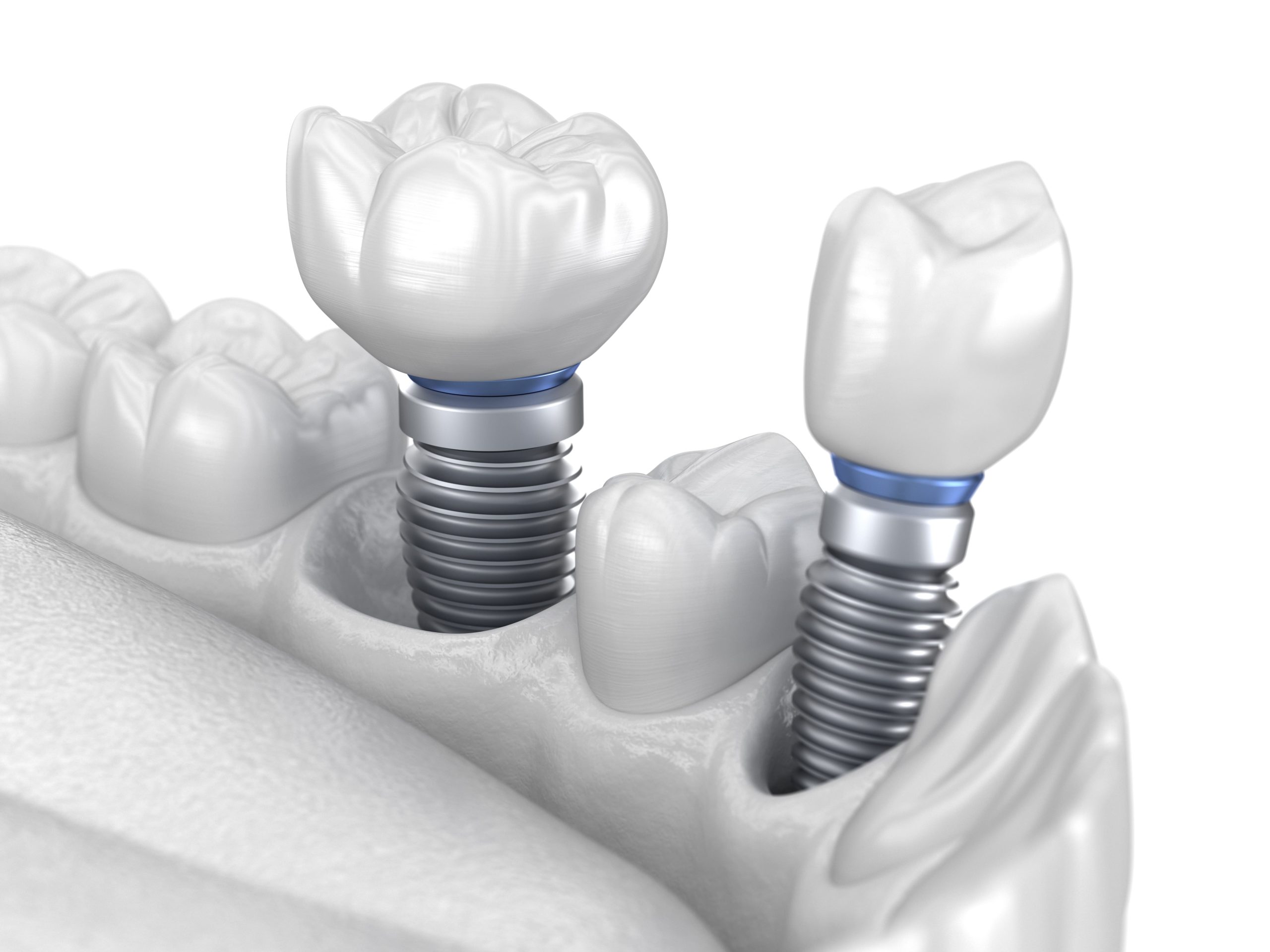 Implantes dentales: ¿En qué casos no son convenientes?