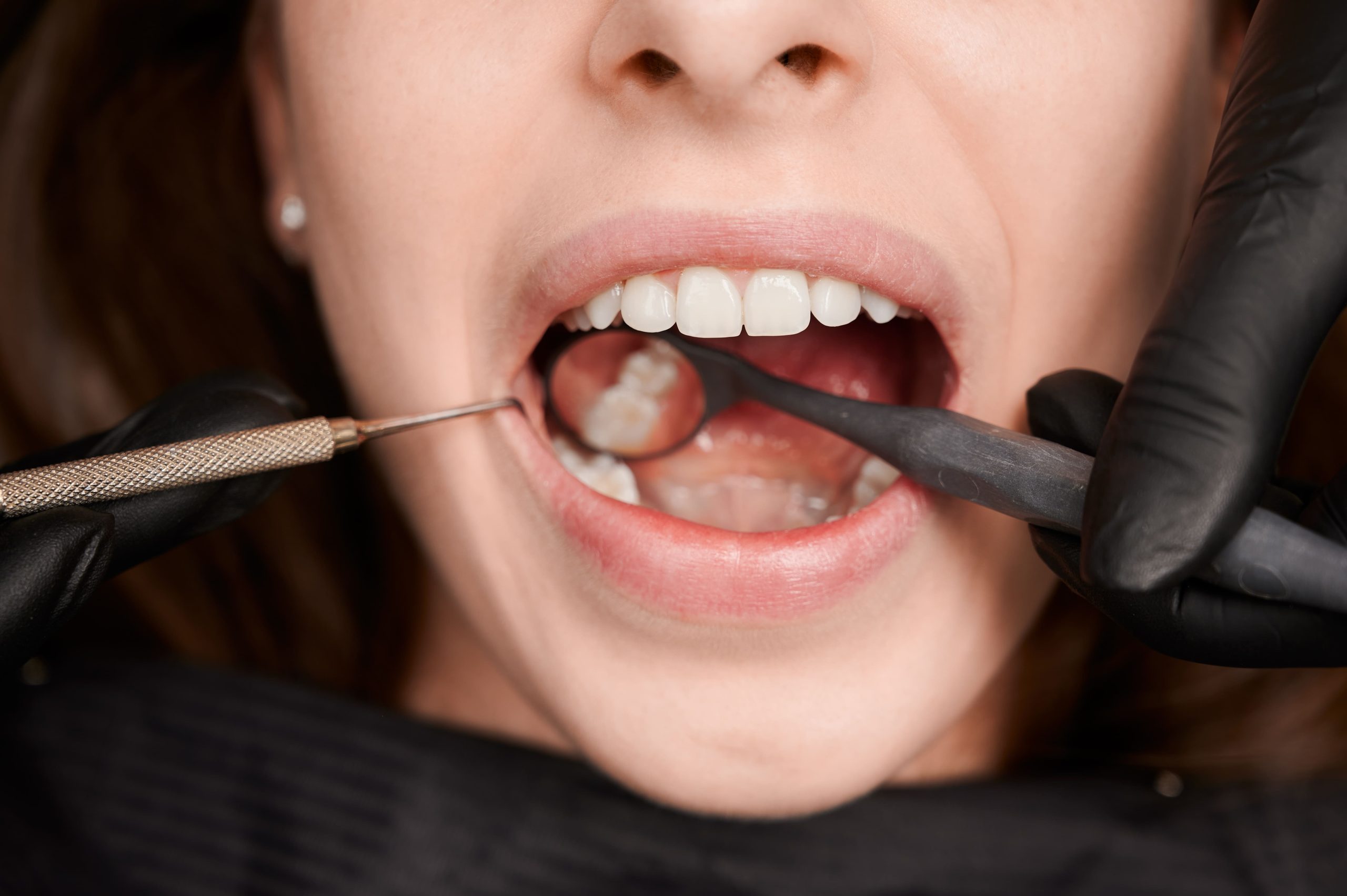 Periodoncia: Tratamiento para el cuidado de tus dientes