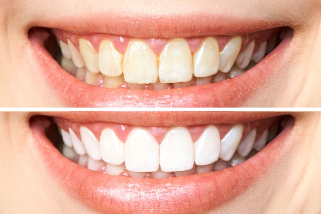 ¿Manchas en tus dientes? El blanqueamiento dental es la solución. Interviene desde manchas superficiales hasta decoloraciones más profundas.