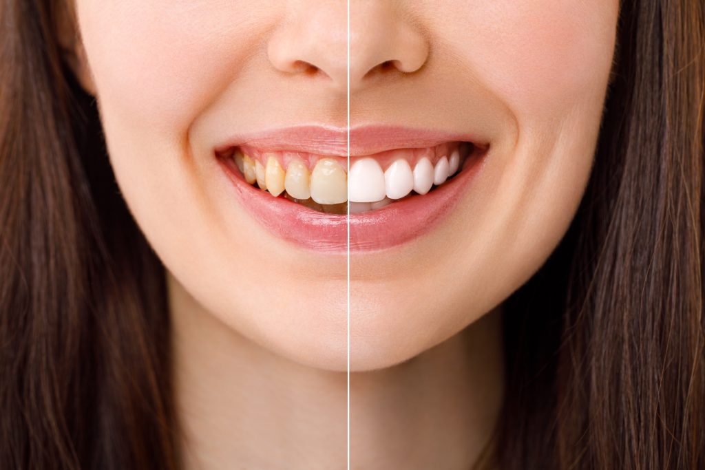 Conoce los secretos del blanqueamiento dental y elige el método perfecto para ti. ¡Comienza hoy a transformar tu sonrisa!