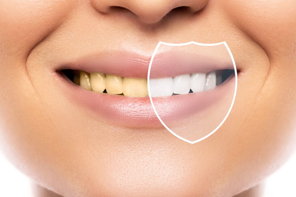 Conoce los tratamientos ideales para lograr el diseño de sonrisa ideal y mejorar tu bienestar bucal. ¡Transforma tu sonrisa hoy!