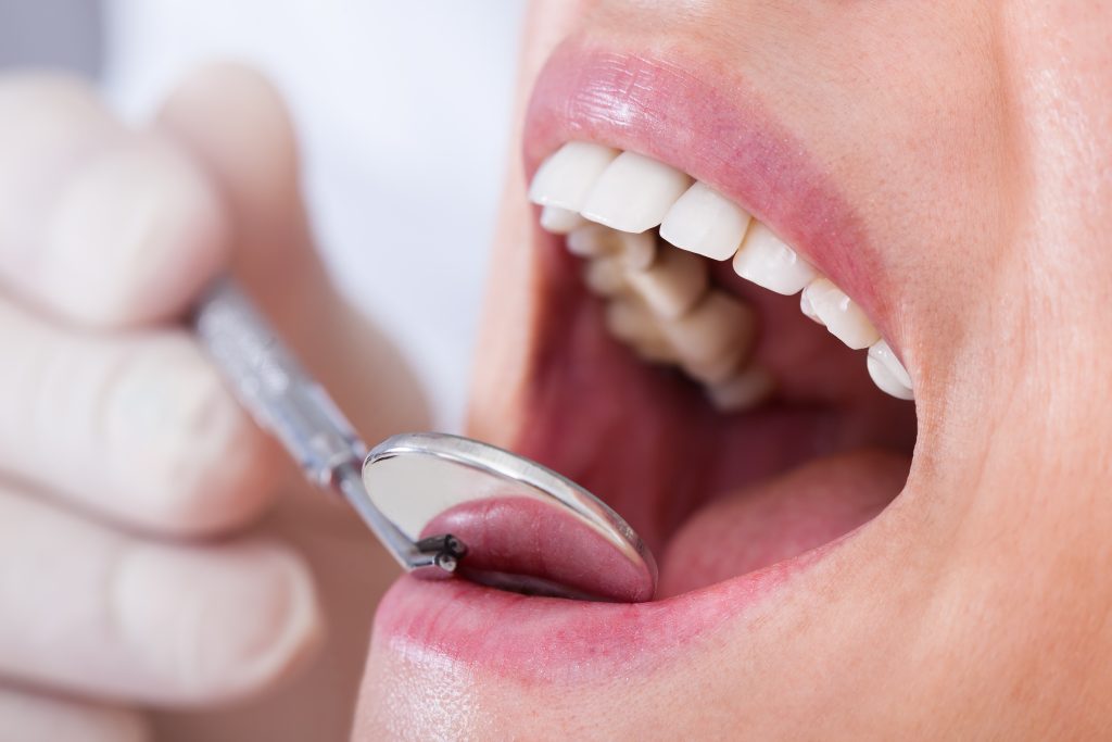 Inspección dental con un espejo odontológico dentro de la boca de un paciente.