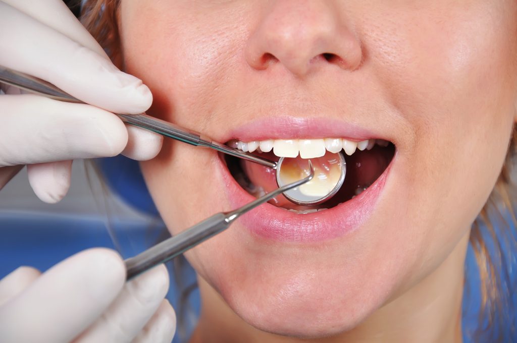 Conoce los secretos del blanqueamiento dental y elige el método perfecto para ti. ¡Comienza hoy a transformar tu sonrisa!