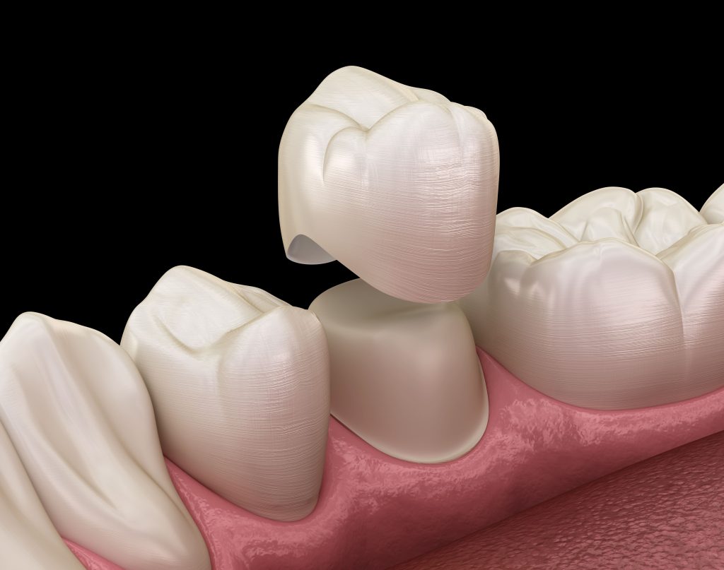 Una corona dental permite cubrir completamente un diente desgastado o fracturado. Descubre los tipos de coronas que existen.