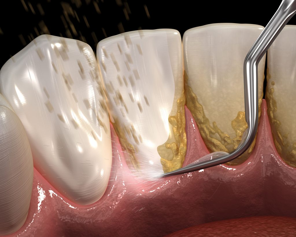 ¡La periodoncia va más allá de una sonrisa bonita! Esta especialidad cuida tus encías, combate enfermedades y preserva el hueso alveolar. 